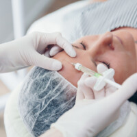 Faltenunterspritzung mit Hyalyron