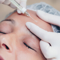 Faltenunterspritzung mit Hyalyron