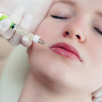 Volumenaufbau der Lippen mit Hyalyron