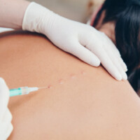 Neuraltherapie nach Huneke