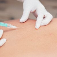 Neuraltherapie nach Huneke