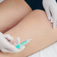 Cellulitebehandlung mit der Mesotherapie