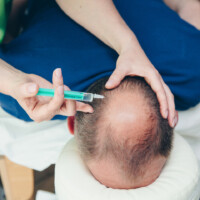 Mesotherapie gegen Haarausfall