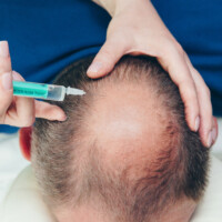 Mesotherapie gegen Haarausfall