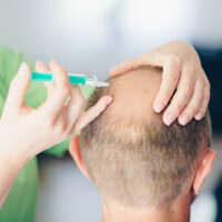 Mesotherapie gegen Haarausfall