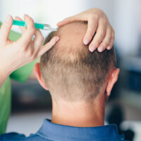 Mesotherapie gegen Haarausfall